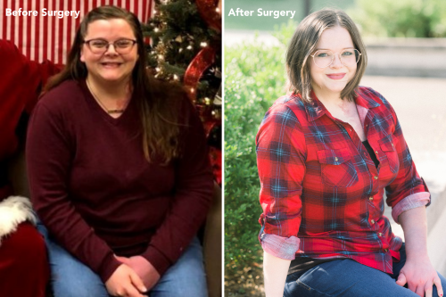 Before and After Bariatric Surgery Before and After Bariatric Surgery