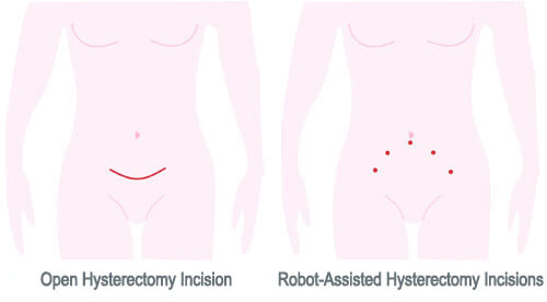 Open Hysterectomy Incision v Robot-Assisted Hysterectomy Incision