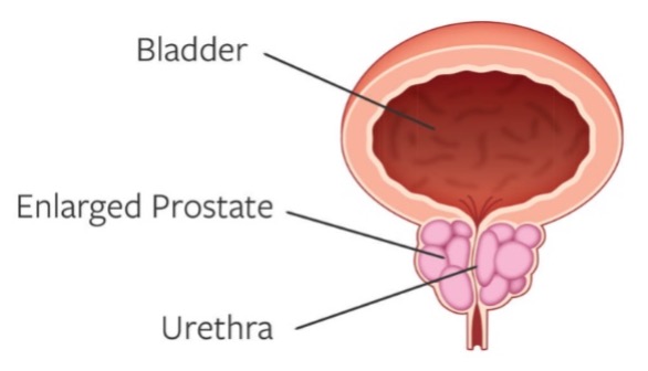 ProstateAbnormal
